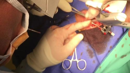 Temporal artery biopsy