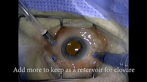 Reservoir Technique: A Novel Method for Pressure-Controlled Silicone Oil Infusion Using the Constellation Vitrectomy System