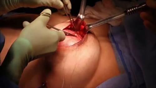 RBCP - Breast reconstruction with implant: creating a pocket with