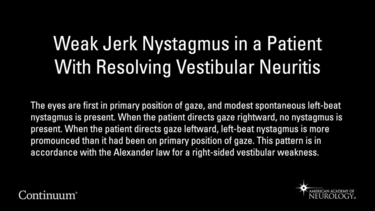 Weak jerk nystagmus in a patient with resolving vestibular neuritis