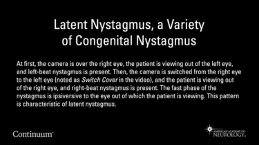Latent nystagmus, a variety of congenital nystagmus