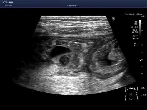 Isolated small bowel varices diagnosed by contrast-enhanced ultrasound