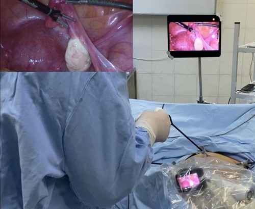 Wireless laparoscopic salpingectomy for ectopic pregnancy.