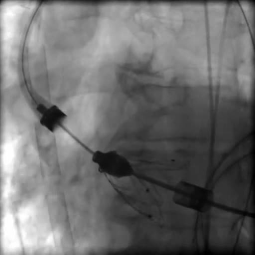 Transapical guidewire and transcatheter heart valve