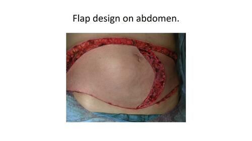 Projection and In-setting of the Tram Flap Breast Reconstruction. Video 6 from “A Safe and Efficient Technique for Pedicled TRAM Flap Breast Reconstruction” June 2023 – 151 (6) CME