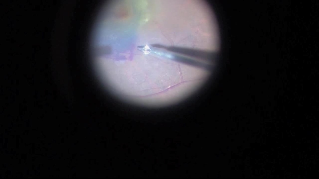 RETINA