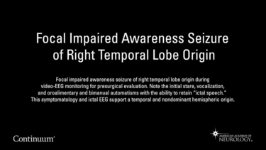Focal impaired awareness seizure of right temporal lobe origin