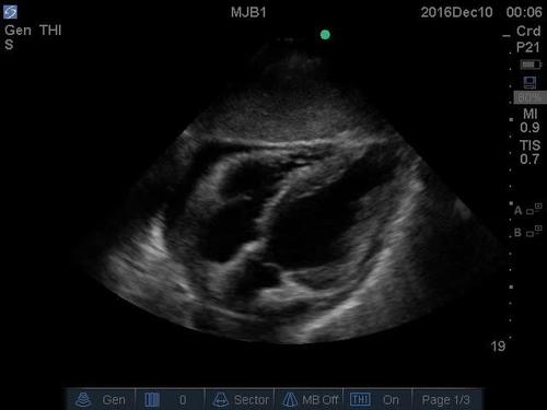 POC ultrasound shock--video 6