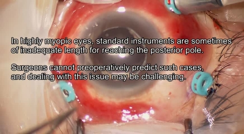 Extending the Limbus-to-Cannula Distance to 6.0 mm During Pars Plana Vitrectomy in Highly Myopic Eyes