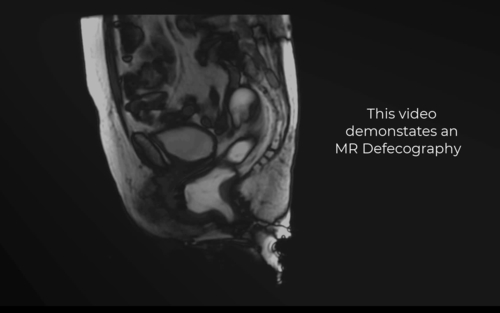 Video 2 ASCRS MRI Final