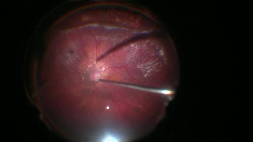 Perfluorodecalin as Medium-Term Tamponade in the Case of Retinal Detachment Recurrence With an Inferior Retinal Break, Which Lies Posteriorly to an Encircling Band