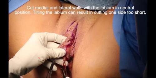 Trim labioplasty: Part 1. Video 1 from “The Safe Practice of Female Genital Plastic Surgery”