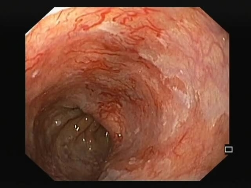 Radiofrequency ablation for esophageal angiectasias and Barrett’s esophagus with underlying varices