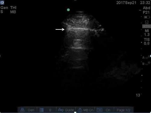 POC ultrasound shock--video 1