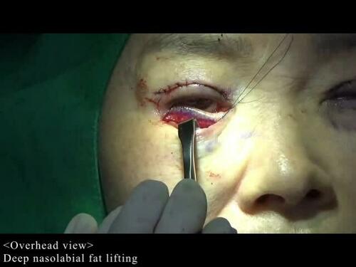 Deep nasolabial fat lifting. Video 5 from “Rejuvenation of the lower eyelid and midface with deep nasolabial fat lift in East Asians.” 151(6).