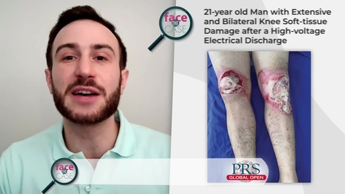 Face the Case- Knee Soft-tissue Reconstruction Post Electrical Burn