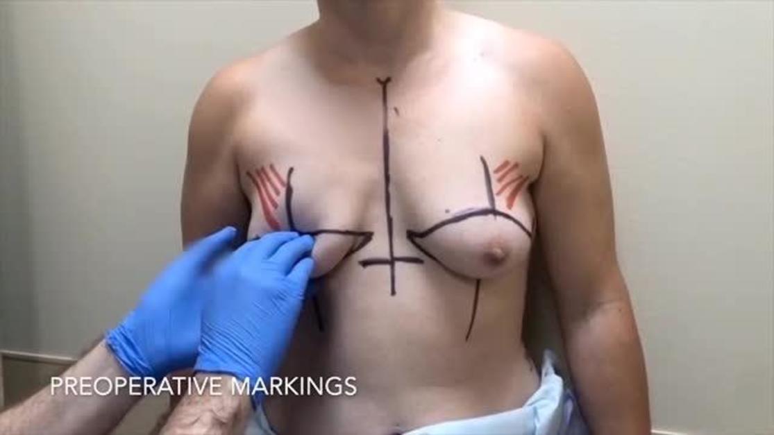 Chest Masculinization Technique and Outcomes in 72 Double-incision