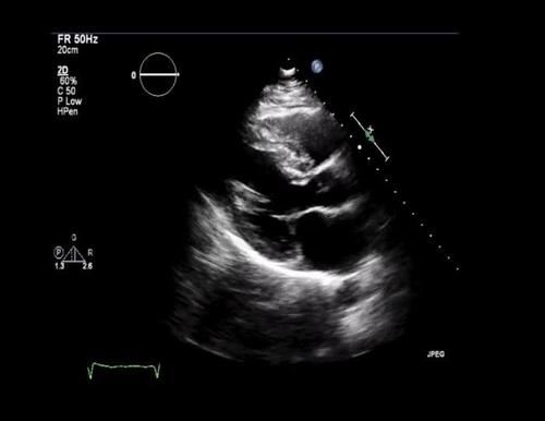 Video 6: Systolic anterior motion of the anterior mitral leaflet in the PLAX