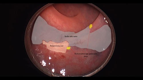 Transanal Endoscopic Operation (TEO) approach to mesorectal lesions: Local excision of lymph node metastasis of neuroendocrine tumor.