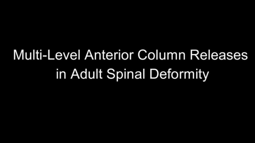 Adult Spinal Deformity Correction with Multi-level Anterior Column Releases: Description of a New Surgical Technique and Literature Review.