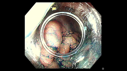 Endoscopic resection of a complex recto-sigmoid lesion using novel technology to prevent long term luminal stricture