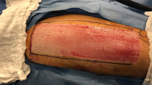 Split-Thickness Skin Grafting: A Primer for Orthopaedic Surgeons