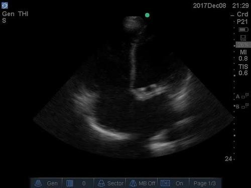POC ultrasound shock--video 3