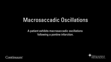 Macrosaccadic Oscillations