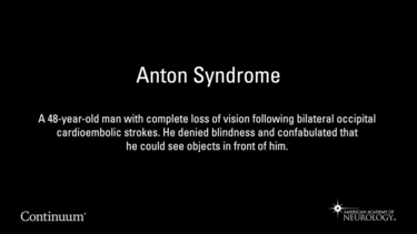 Anton Syndrome