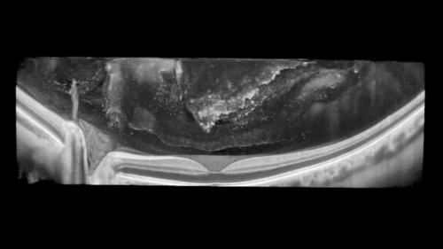 IMAGING THE VITREOUS WITH A NOVEL BOOSTED OPTICAL COHERENCE TOMOGRAPHY TECHNIQUE: Vitreous Degeneration and Cisterns (Video 8)