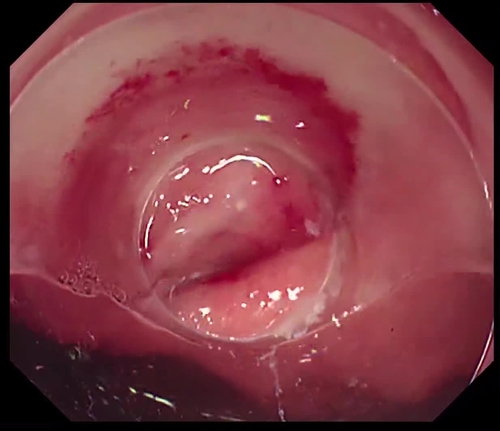 Salvage procedure for double trouble in lumen-apposing metal stent misdeployment during EUS-guided gastroenterostomy: ready to start again