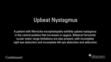 Upbeat Nystagmus