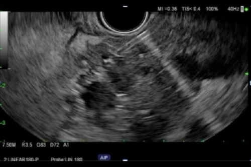 Antegrade pancreatoscopy with electohydraulic lithotrypsy via an EUS guided pancreaticogastrostomy for the removal of obstructing pancreatic stones