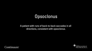 Opsoclonus