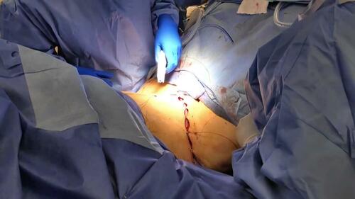 Body Lift Procedure Steps  American Society of Plastic Surgeons