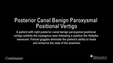 Posterior Canal Benign Paroxysmal Positional