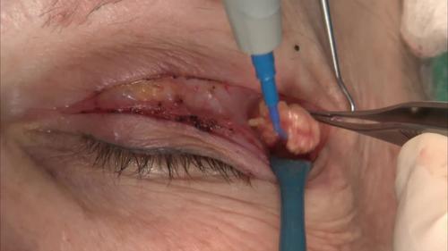 Eyelid surgery store video