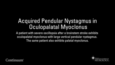 Acquired Pendular Nystagmus in Oculopalatal Myoclonus