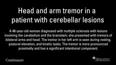 Head and arm tremor in a patient with cerebellar lesions