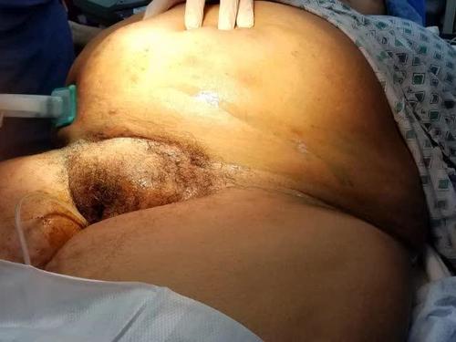 Cesarean delivery incision technique for the obese parturient