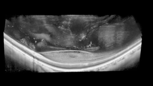 IMAGING THE VITREOUS WITH A NOVEL BOOSTED OPTICAL COHERENCE TOMOGRAPHY TECHNIQUE Posterior Vitreous Detachment (Video 4)