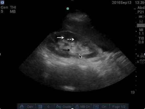 POC ultrasound kidneys--video 1