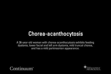 Chorea-acanthocytosis