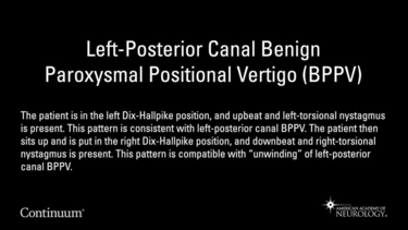 Left-posterior canal benign paroxysmal positional vertigo (BPPV)