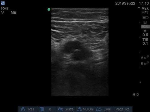 POC ultrasound shock--video 5