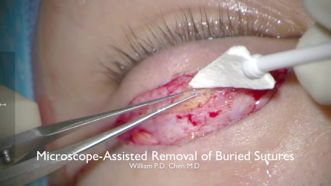 Blepharoplasty sutures clearance