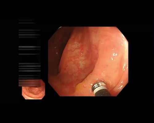 Effective endoscopic delineation with acetic acid  spray and narrow-band imaging in underwater endoscopic mucosal resection for SSL