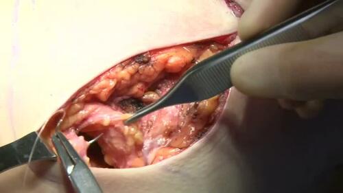 Simultaneous Short-Scar Superior-Pedicle Mastopexy Augmentation with Breast Tissue Equalization. Video from “Superiorly-Based Short-Scar Mastopexy Augmentation: A 10-Year Review of 1217 Consecutive Cases.” 151(6).