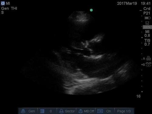 POC ultrasound shock--video 8