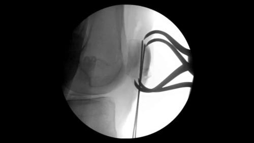 ORIF Patella Fracture with Tension Band Construct